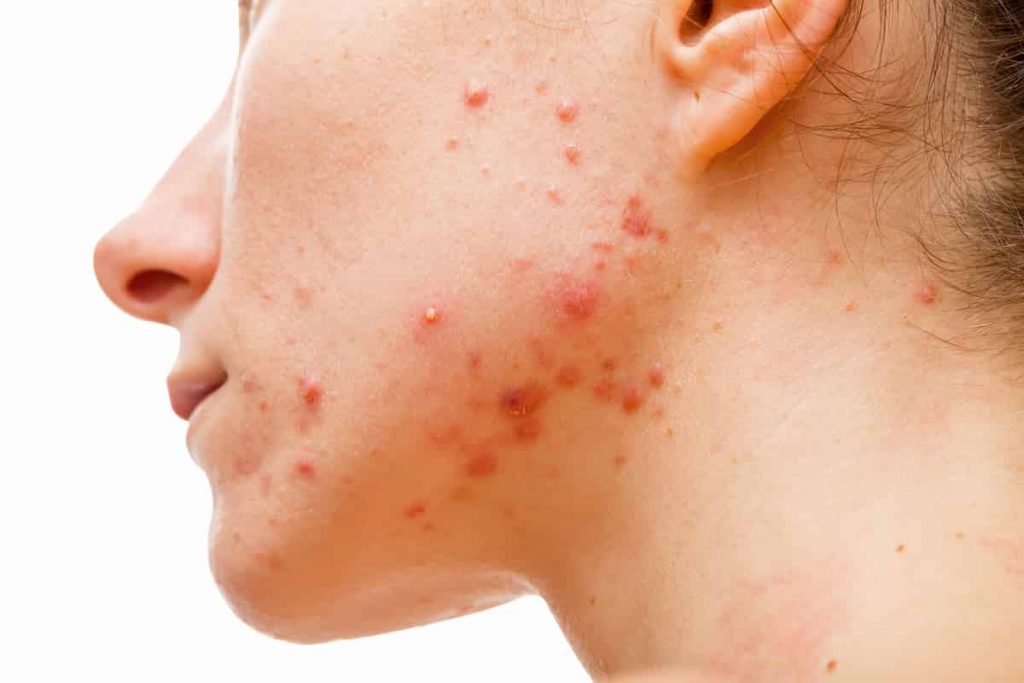 Female with Acne on chin and neck.