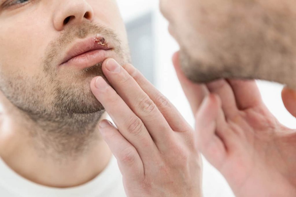 Man with mouth herpes | How common is herpes in the UK? | e-Surgery
