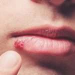 Can You Treat Herpes At Home?