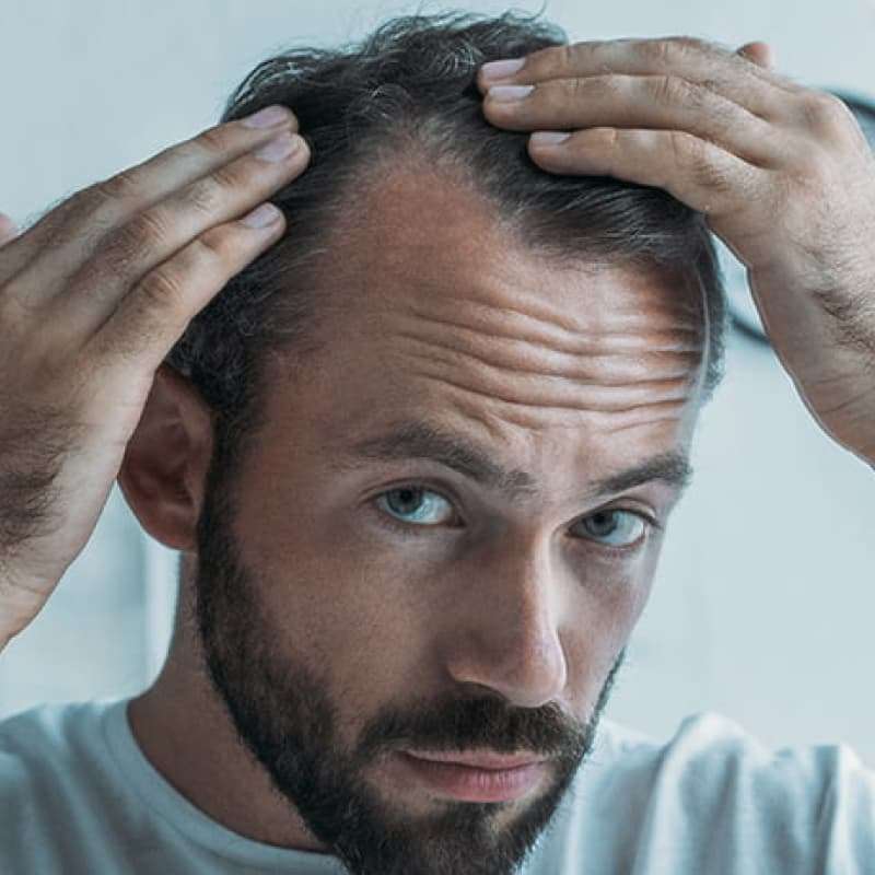 Hair Loss, middle aged man looking into a mirror separating his hair at the parting and inspecting his receding hair line | e-Surgery