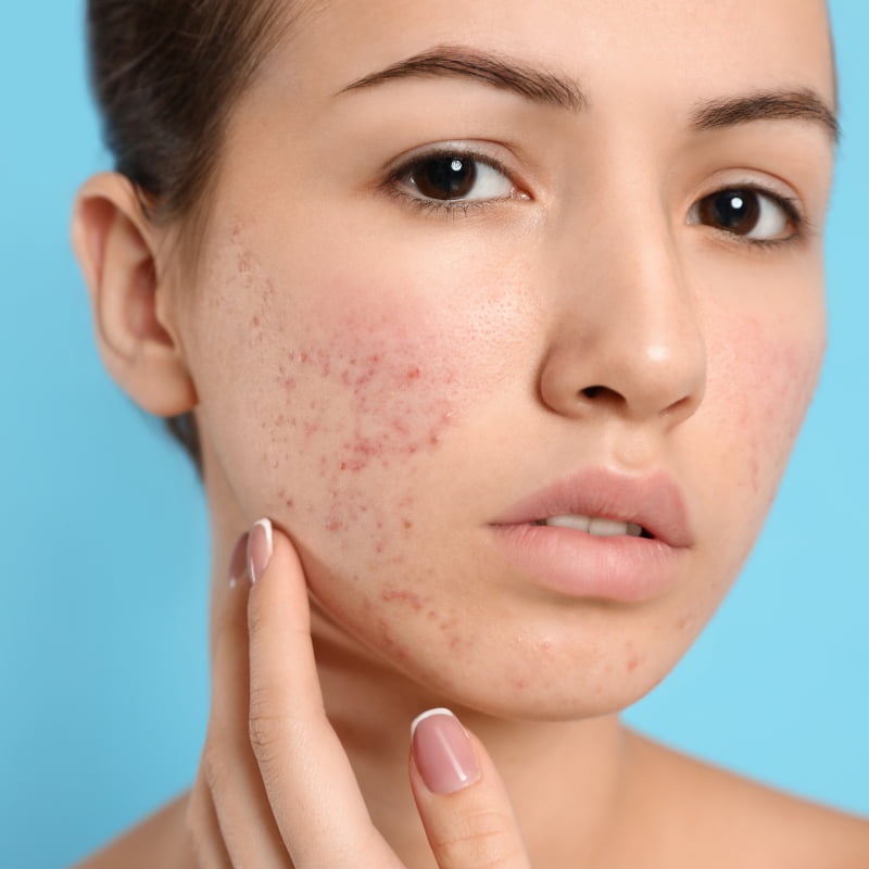 woman with acne caring for her skin | e-Surgery