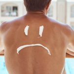 How to sleep with sunburn: Top 5 Home Remedies