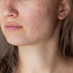 What is ‘skin purging’ and how long does it last?