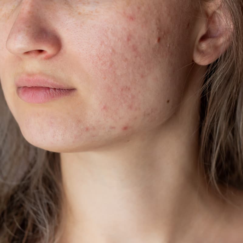 Woman struggling with skin purging