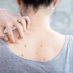Where Can I Get ‘Bacne’ Treatment Uk? Back Acne Causes & Treatment